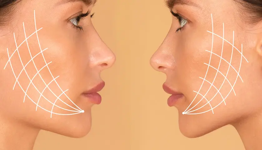 Dos perfiles de mujer con líneas blancas que simulan el efecto de un tratamiento facial. El antes y después de Thermage FLX para una piel más firme.
