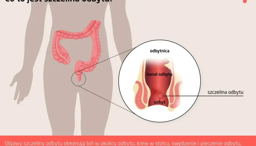 Ilustracja pokazuje anatomię odbytu z zaznaczoną szczeliną. Objawy szczeliny odbytu to ból, krwawienie i pieczenie.