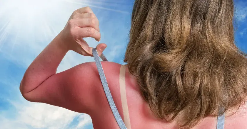 Skuteczne leki na oparzenia słoneczne, które przyniosą ulgę i szybkie wyleczenie