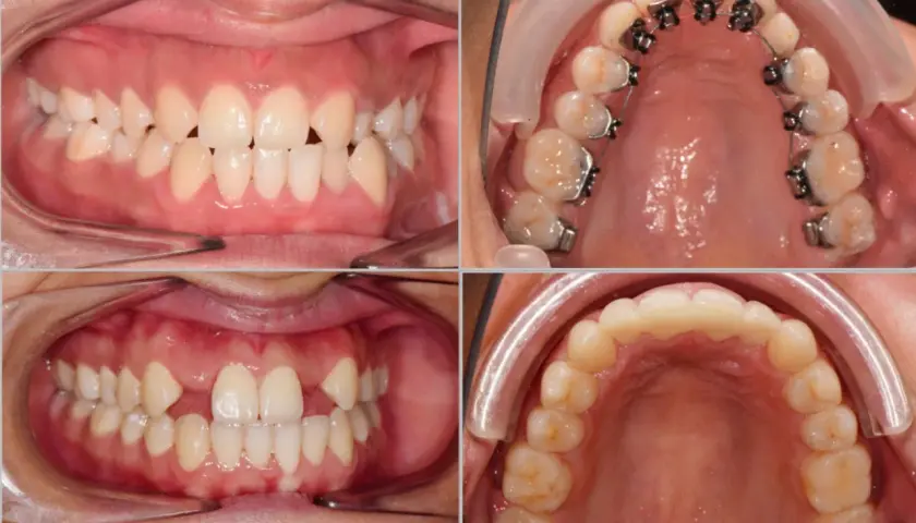 Denti con agenesia dentale, alcuni con apparecchio ortodontico, in diverse viste.