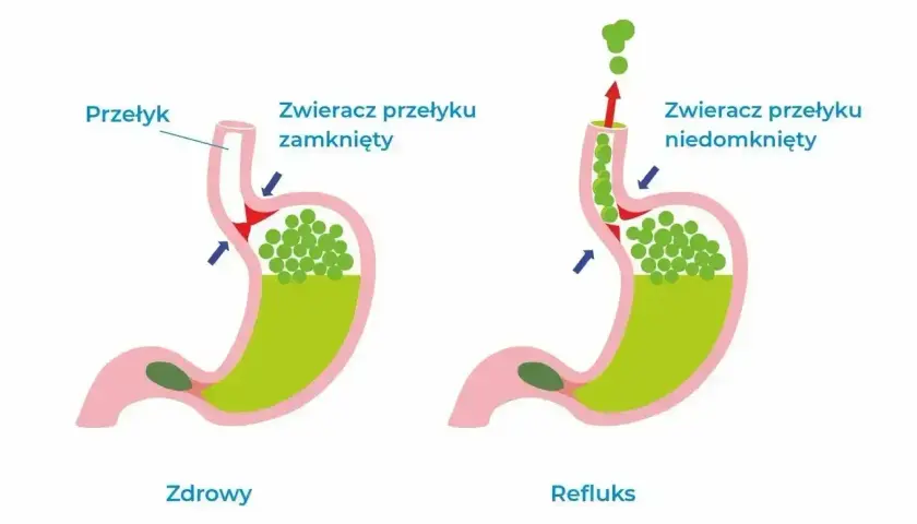 Zdrowy żołądek vs. refluks. U zdrowego zwieracz przełyku jest zamknięty, a przy refluksie niedomknięty, co powoduje cofanie się treści żołądkowej i uczucie guli w gardle.