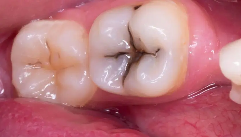 Dente con carie profonda che necessita di cure. La cavità scura è ben visibile nella fessura centrale.