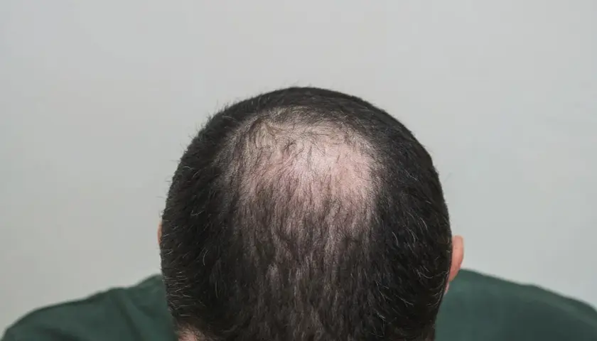 Vista superior de la cabeza de un hombre mostrando la pérdida de cabello, un ejemplo de alopecia androgénica que es común.