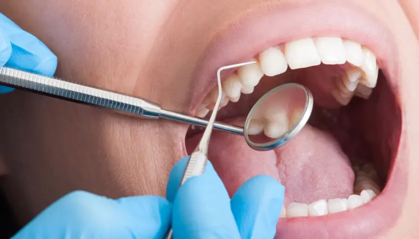 Bocca aperta con strumenti dentistici. La pulizia dei denti fa male? Forse, ma necessaria per un sorriso smagliante.