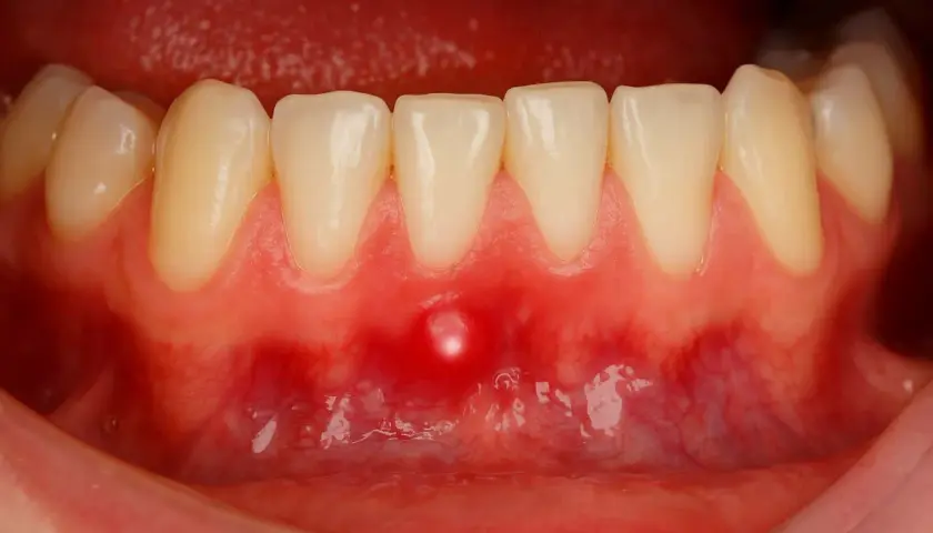 Una piccola bolla sulla gengiva, rossa e gonfia, vicino ai denti inferiori.