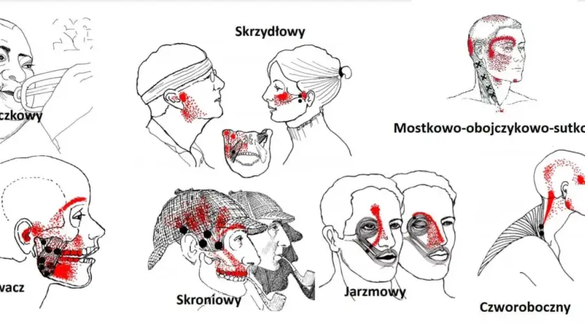 Ilustracje przedstawiają punkty spustowe bólu w mięśniach: policzkowym, żwaczu, skroniowym, jarzmowym, skrzydłowym i potylicznym.