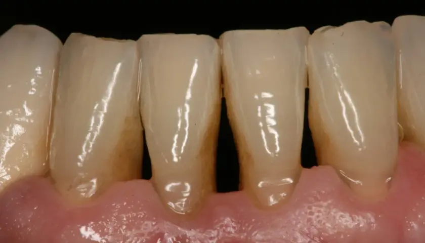 Dientes con acumulación de sarro y encías inflamadas, signos de periodontitis causas.