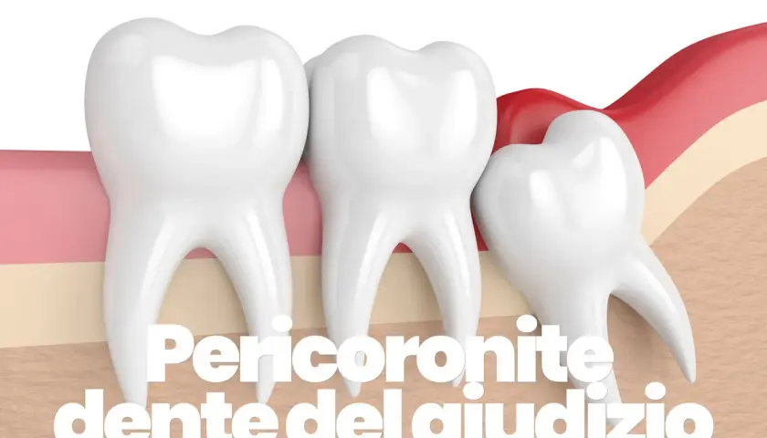Dente del giudizio parzialmente coperto dalla gengiva, causa di pericoronite.