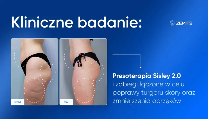 Przed i po zabiegu presoterapii Sisley 2.0. Widoczne spektakularne presoterapia efekty: poprawa jędrności skóry i redukcja obrzęków.