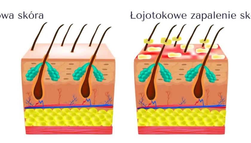 Ilustracja porównująca zdrową skórę głowy z łojotokowym zapaleniem skóry, pokazująca mieszki włosowe i gruczoły łojowe.