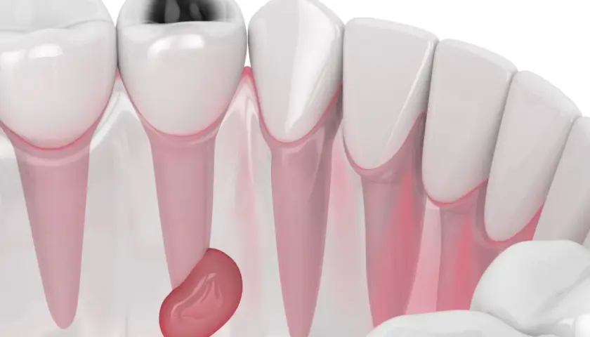 Dente cariato con ascesso gengivale. Si cercano rimedi della nonna, ma la situazione richiede attenzione medica.