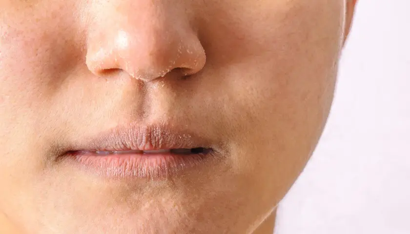 Nahaufnahme eines Gesichts mit trockener, schuppiger Haut um Mund und Nase, was auf periorale Dermatitis am Kinn hindeuten könnte.