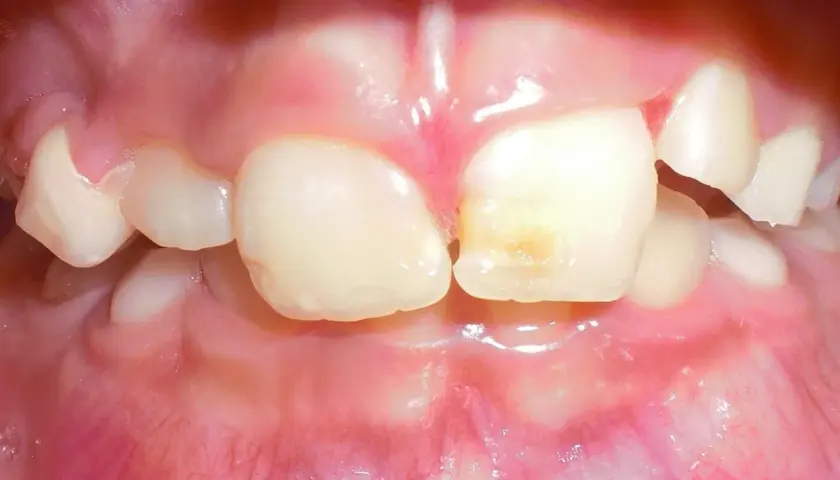Dientes infantiles con caries incipiente. El flúor ayuda a fortalecer el esmalte y previene futuras caries.