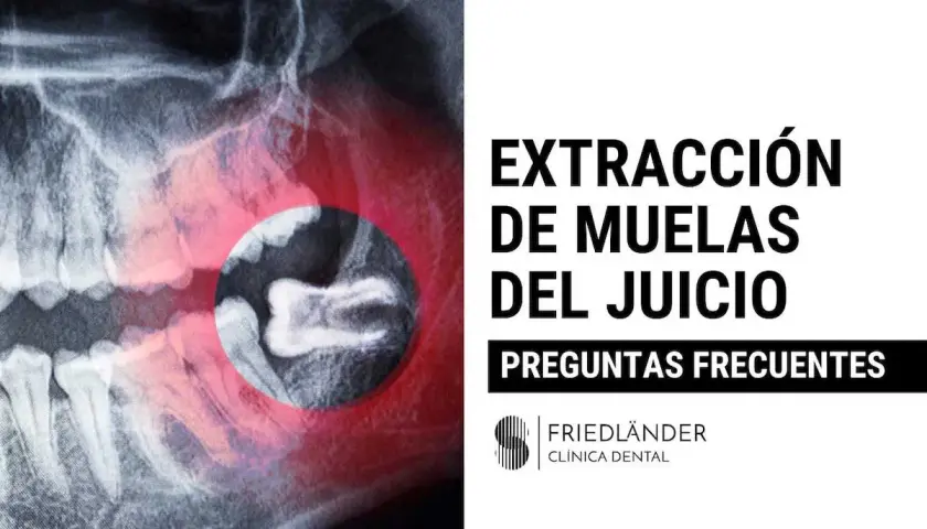 Radiografía dental muestra la extracción de muelas del juicio. Texto: "Extracción de Muelas del Juicio. Preguntas Frecuentes.