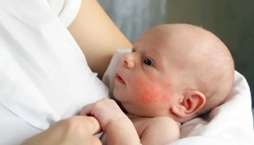 Malutkie dziecko z zaczerwienionymi policzkami, objawami azs u niemowlaka, tulone przez bliską osobę.