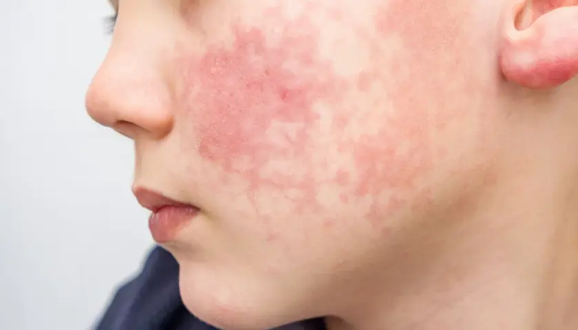 Visage d'enfant marqué par une rougeur diffuse et des plaques, symptômes de dermatite atopique aggravée par la transpiration.