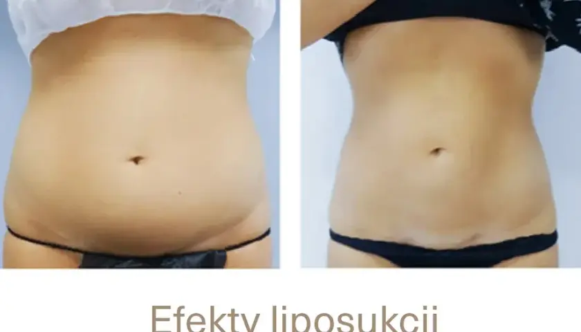 Po liposukcji tłuszcz wraca? Nie! Jak utrzymać nową sylwetkę