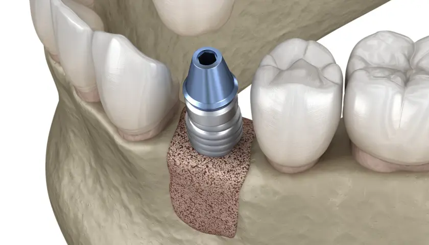 Impianto dentale inserito nell'osso mascellare, pronto per l'integrazione. L'osso autologo offre una base solida per il successo del trattamento.