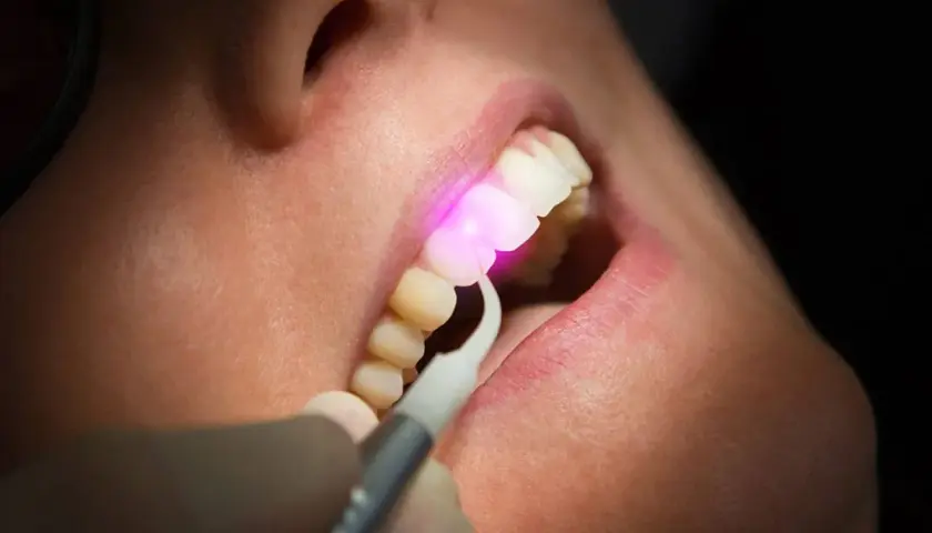 Trattamento gengivale con laser, un raggio rosa illumina i denti e le gengive.
