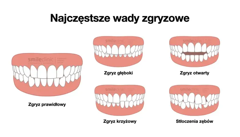 Krzywe zęby, brak pieniędzy na aparat. Ilustracje pokazują różne wady zgryzu: prawidłowy, głęboki, otwarty, krzyżowy i stłoczenia.