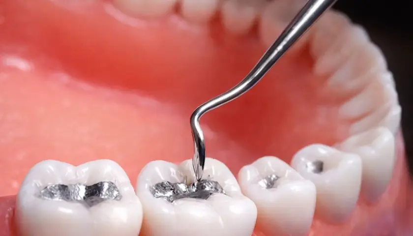 Un dentista aplica una amalgama dental a una muela.