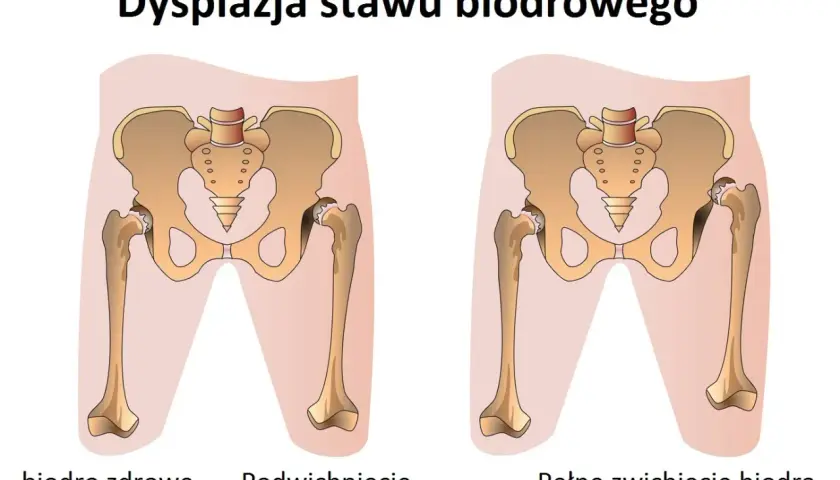 Ilustracja porównująca zdrowe biodro, podwichnięcie i pełne zwichnięcie biodra.