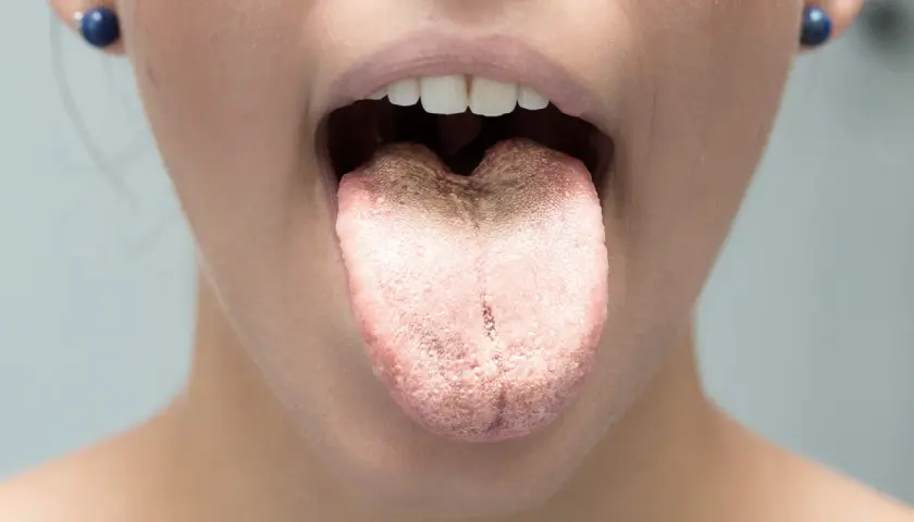 Lingua con patina biancastra e ruvida, possibile sintomo di candida orale cause.