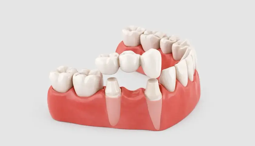 Modello di un ponte dentale con ganci che sostituisce un dente mancante, ancorato a pilastri naturali.