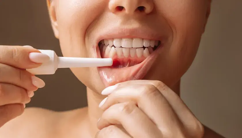 Donna applica un trattamento per la stomatite ulcerosa su una lesione gengivale.