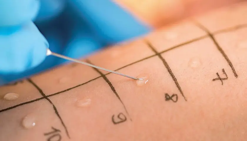 Allergietest auf der Haut: Eine Nadel mit einer Flüssigkeit wird auf markierte Felder aufgetragen, um eine mögliche eibisch allergie zu identifizieren.