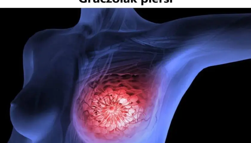 Schemat piersi z uwidocznionym gruczolakiem w czerwonym kolorze.