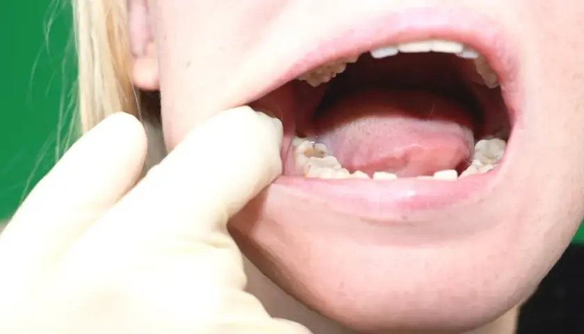 Ból zęba mądrości (ósemki): Szybka ulga i kiedy do dentysty?