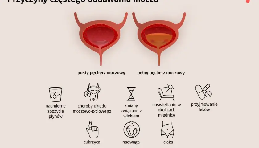 Ilustracja przedstawia pęcherz moczowy pusty i pełny, wyjaśniając przyczyny częstego oddawania moczu, w tym poliurię, np. nadmierne picie, choroby, wiek, leki, cukrzycę, nadwagę, ciążę.