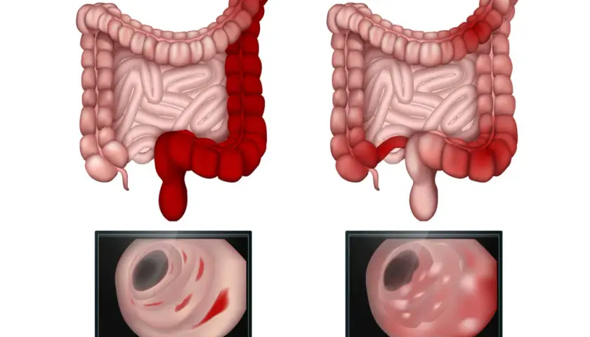 Morbus Crohn Symptome: Erkennen Sie die alarmierenden Anzeichen