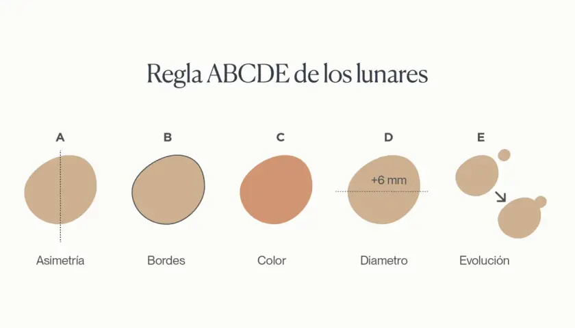 Regla ABCDE para identificar lunares malignos: Asimetría, Bordes irregulares, Color variado, Diámetro mayor a 6mm y Evolución.