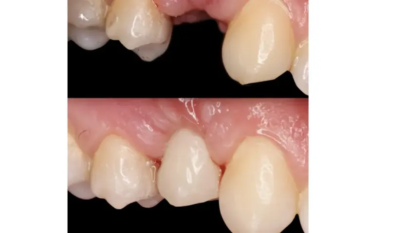 Prima e dopo un ponte dentale Maryland. Si notano i potenziali svantaggi: recessione gengivale e possibile infiltrazione.