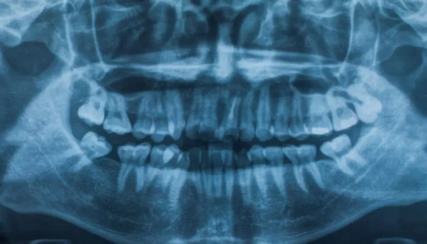 Radiografía panorámica dental que muestra la dentadura completa. Se aprecian signos de posible traumatismo dental, como dientes fracturados o desplazados.