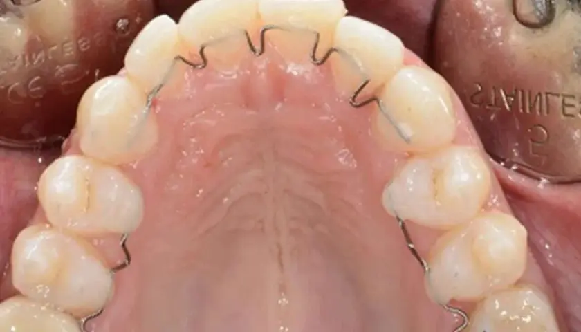 Dente cariato con apparecchio ortodontico. La carie è visibile su un dente, mentre gli altri sono allineati da un filo metallico.