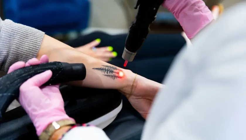 En person får bort en gammal lasra tatuering med en laserbehandling.