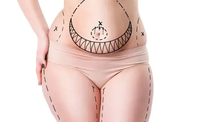 Kropp med markerade linjer för fettsugning, visar områden för vaser liposuction.