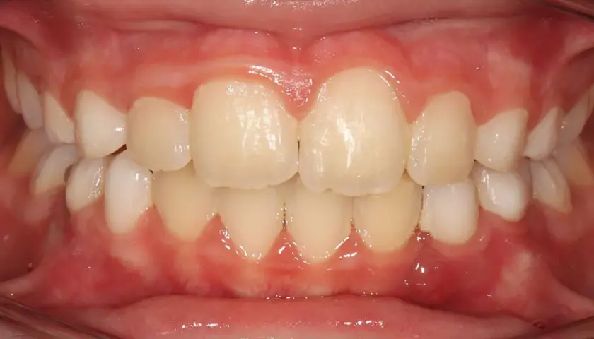 Dientes alineados y encías sanas, un vistazo al progreso de Invisalign mes a mes.