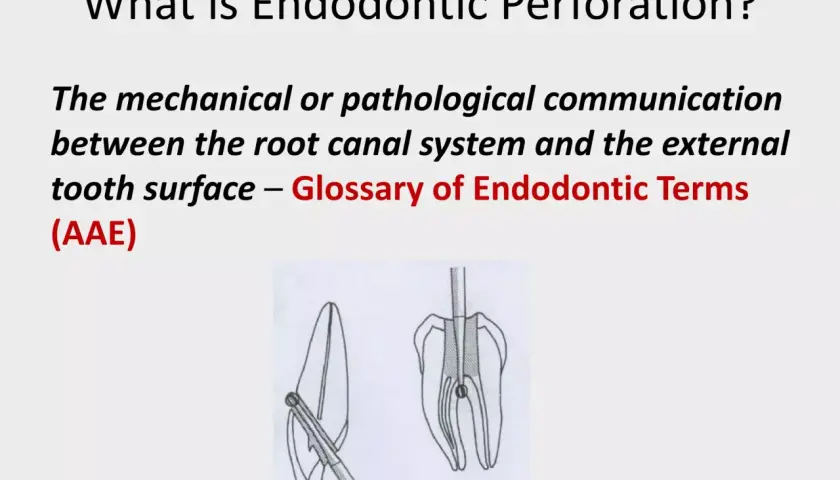 Co to jest perforacja endodontyczna? Ilustracja pokazuje komunikację między systemem kanałów korzeniowych a zewnętrzną powierzchnią zęba.