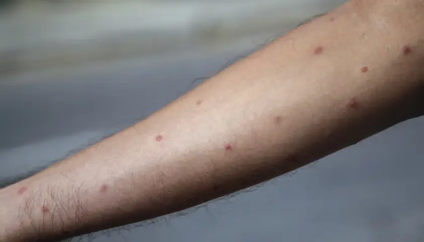 Arm täckt av röda prickar, troligen från pissmyra bett.
