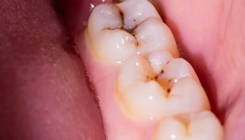 Muelas con caries y encía rosada. Para empastar una muela hace falta anestesia, ¡pero el resultado vale la pena!