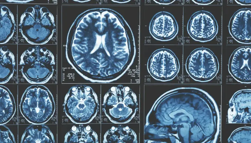Imágenes de resonancia magnética cerebral. Cortes axiales y sagitales que muestran la estructura del cerebro, como si fuera una memoria fotogénica.