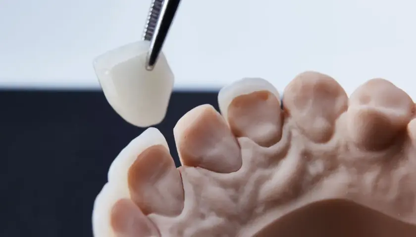 Precyzyjne dopasowanie korony porcelanowej na metalu do modelu szczęki.