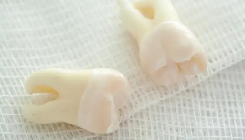 Jak płukać dziąsła po usunięciu zęba? Uniknij suchego zębodołu!