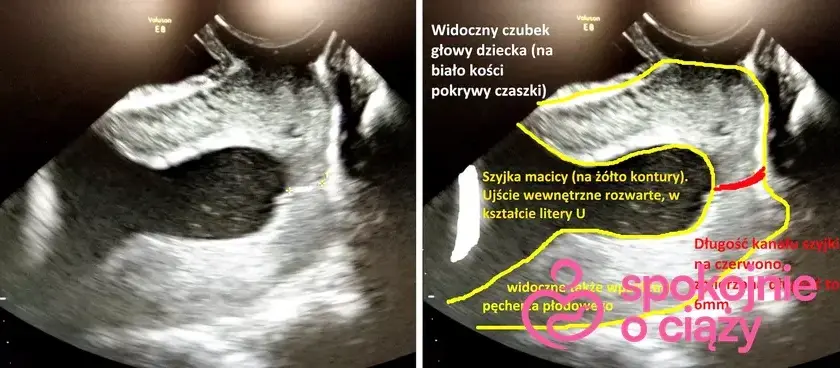Skrócona szyjka macicy a poród: Kiedy spodziewać się rozwiązania?