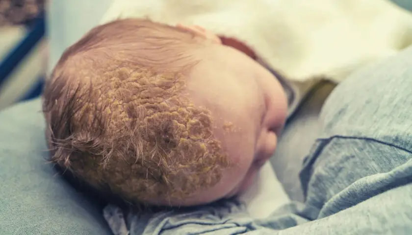Testa di neonato con croste di dermatite seborroica, comunemente chiamata "crosta lattea".