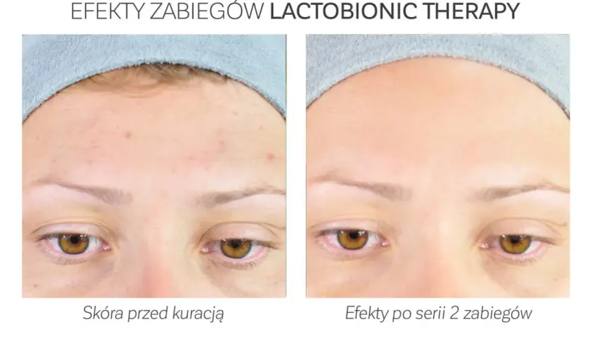 Przed i po zabiegu z kwasem laktobionowym: skóra z niedoskonałościami staje się gładka i czysta.